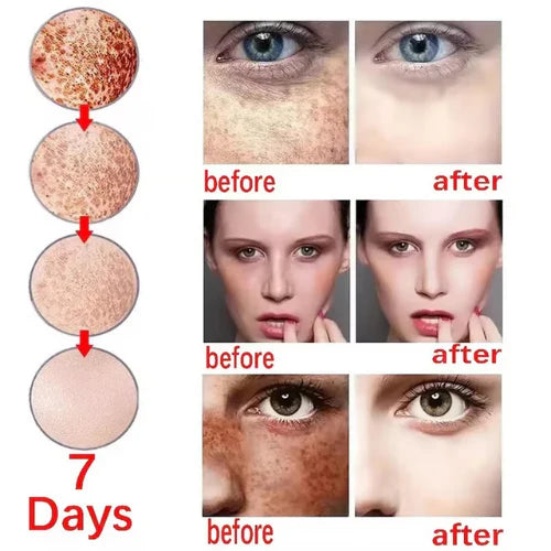 โค๏ธ ORIGINAL ๐๐ก๐ข๐ญ๐๐ง๐ข๐ง๐ and ๐
๐ซ๐๐๐ค๐ฅ๐ Removing Essence, Vitamin C ๐๐ฅ๐๐ฆ๐ข๐ฌ๐ก Serum for ๐๐๐ฅ๐๐ฌ๐ฆ๐ ๐๐๐ฆ๐จ๐ฏ๐๐ฅ, ๐๐ง๐ญ๐ข-๐ฌ๐ฉ๐จ๐ญ Face Serum (๐ฅBuy 1 Get 1 FREE Today Only) - Pack of 2