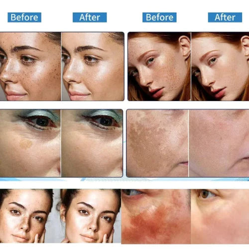 โค๏ธ ORIGINAL ๐๐ก๐ข๐ญ๐๐ง๐ข๐ง๐ and ๐
๐ซ๐๐๐ค๐ฅ๐ Removing Essence, Vitamin C ๐๐ฅ๐๐ฆ๐ข๐ฌ๐ก Serum for ๐๐๐ฅ๐๐ฌ๐ฆ๐ ๐๐๐ฆ๐จ๐ฏ๐๐ฅ, ๐๐ง๐ญ๐ข-๐ฌ๐ฉ๐จ๐ญ Face Serum (๐ฅBuy 1 Get 1 FREE Today Only) - Pack of 2